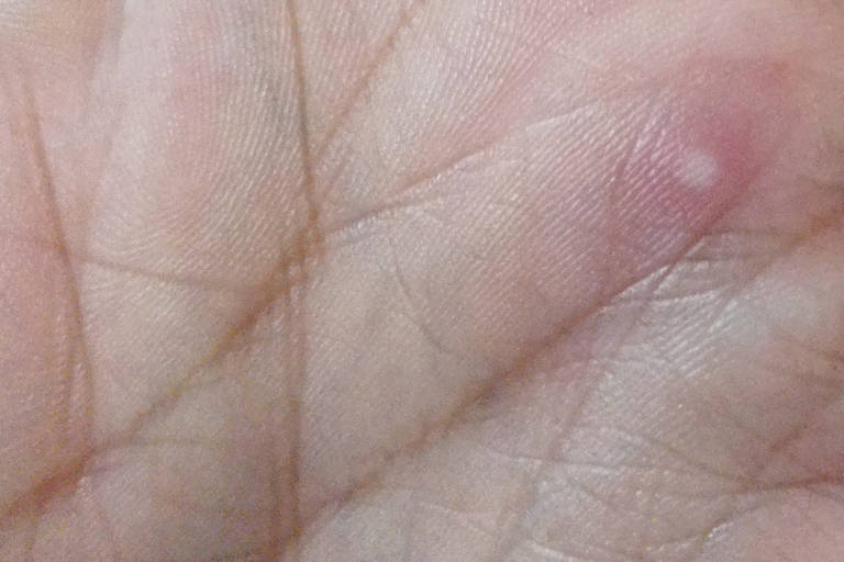 Lesões sutis podem confundir diagnóstico da Mpox