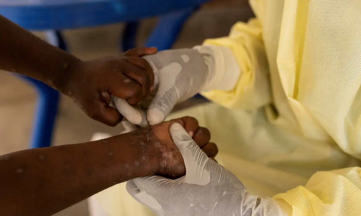 FILE PHOTO: Christian Musema, a laboratory nurse, takes a sample from a child declared a suspected case of Mpox at the treatment centre in Munigi, following Mpox cases in Nyiragongo territory near Goma, North Kivu province, Democratic Republic of the Congo July 19, 2024. Reuters/Arlette Bashizi/Proibida reprodução