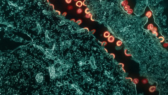 HIV: cientistas anunciam novo caso de remissão, diferente dos anteriores; entenda