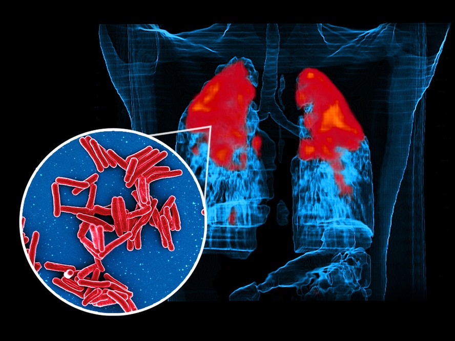 Bactéria causadora da tuberculose acomete principalmente os pulmões, mas também impacta outros órgãos.