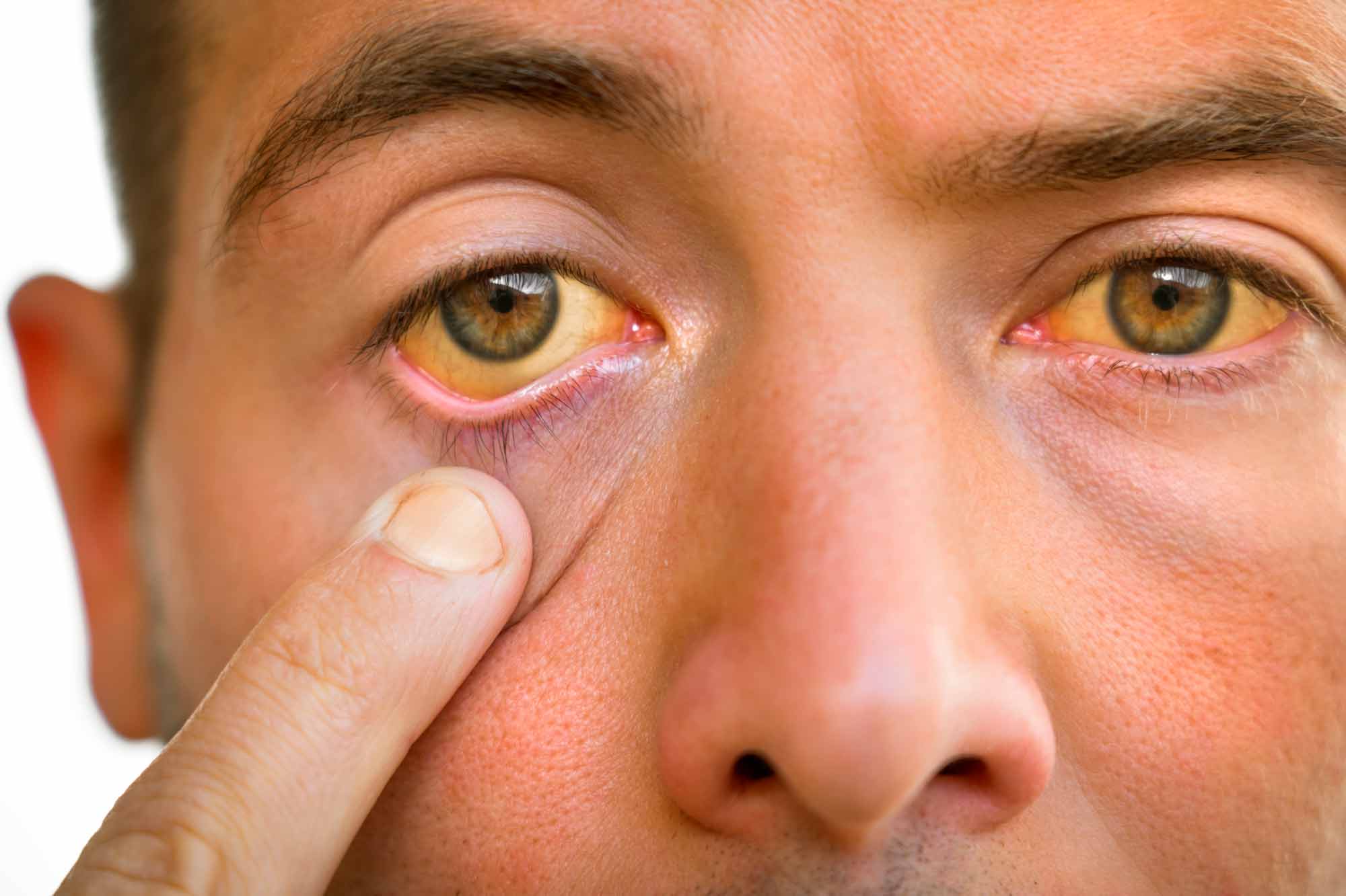 Hepatites virais: quadro clínico, diagnóstico e tratamento