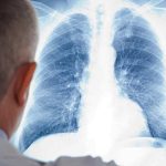 Ministério da Saúde reforça ações de resposta à tuberculose com monitoramento de projeto em Santa Catarina