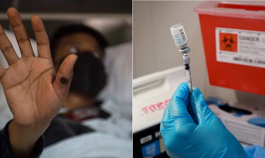 Mpox volta a acender alerta da OMS.