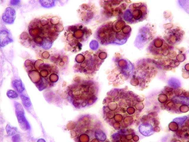 Histoplasmose - causas, sintomas, diagnóstico e tratamento - Doenças - InfoEscola