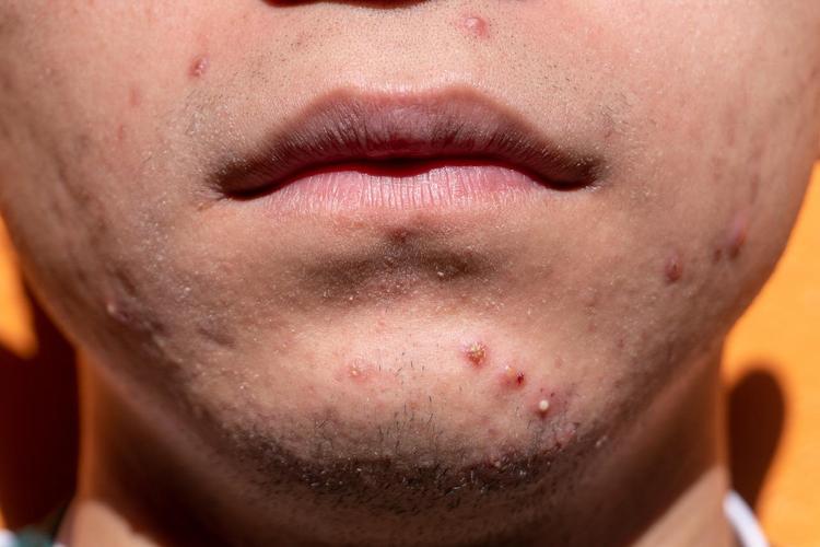 Homem com acne