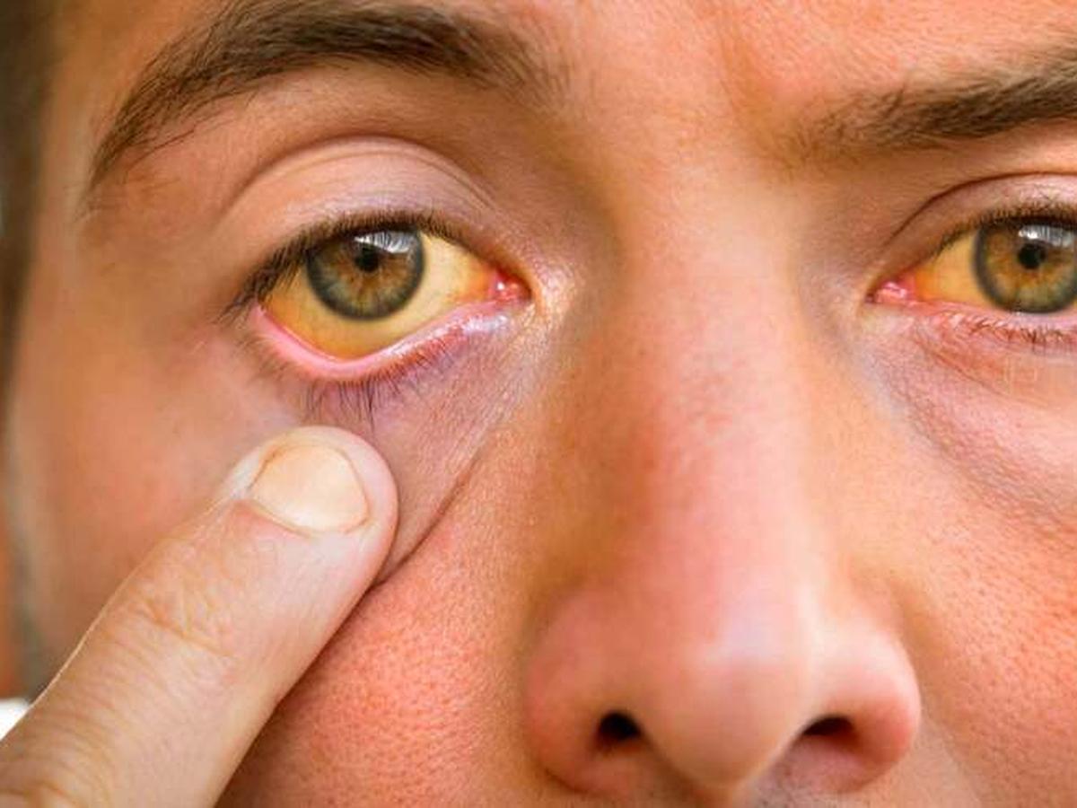 Sintomas e riscos das hepatites A e B: o que fazer para se proteger? - Saúde - Estado de Minas