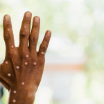 Folha de S. Paulo: Mpox tem cura? Há vacina? Veja as perguntas mais buscadas no Google sobre a doença