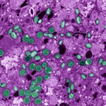 Três casos de mpox ligados a doença grave preocupam especialistas em saúde nos EUA, segundo o Globo