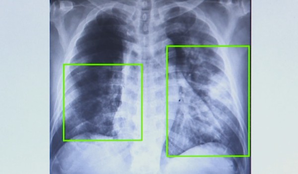 Atendimentos por pneumonia quase dobram em 7 meses na região de Campinas. — Foto: Reprodução EPTV