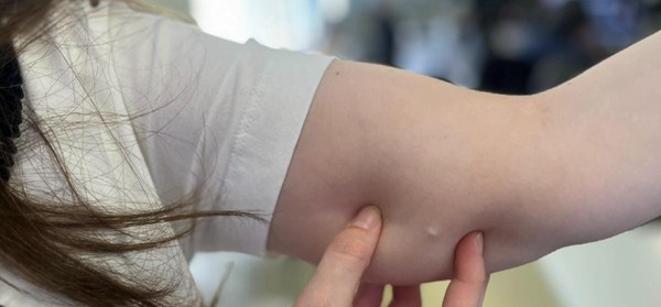 Implanon passa a ser oferecido pelo SUS no Paraná — Foto: Sesa/Reprodução