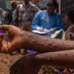 Boa notícia: Mpox deixou de ser emergência de saúde pública na África, anuncia agência da UA