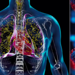 Velha inimiga: por que a tuberculose ainda não é uma doença do passado – Veja