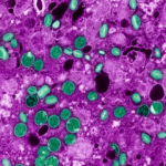 O Globo/ Mpox: tudo que se sabe sobre a doença e como se prevenir