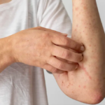 O Globo: Opas recomenda reforço da vacinação contra sarampo para a Copa do Mundo de 2026