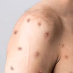 Nova cepa do vírus da Mpox recombinante preocupa OMS e testes mostram que antiviral mais usado não é eficaz – G1