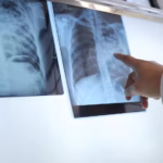 Série de webinars TB/HIV: Inovações diagnósticas para a detecção precoce da tuberculose em pessoas vivendo com HIV – OPAS