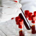 Especialistas publicam primeiras recomendações internacionais para orientar manejo da viremia de baixo nível no HIV